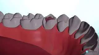 Dental root treatment