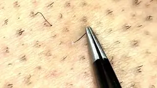 satisfying ingrown hair removal/plucked