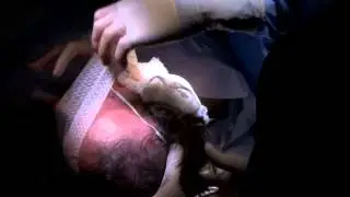 Mastoid Dressing - resident teaching video