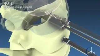 HAP-91 - Artrodese - Cage Cervical - JHS Biomateriais