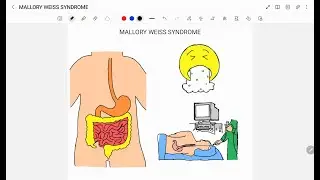 MALLORY WEISS SYNDROME