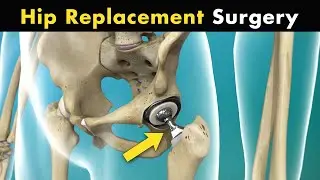 How Hip Replacement Surgery Is Performed? | Hip Arthroplasty (3D Animation)
