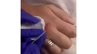 Удаление Бородавки в клинике Аура
