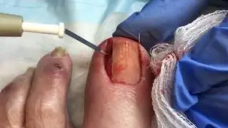 Wedge Resection of Ingrown Toenail
