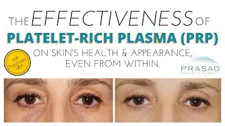 Effectiveness of Platelet-Rich Plasma (PRP) for Skin and Facial Rejuvenation