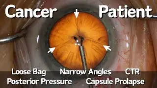 Cataract Surgery for a Cancer Patient on Chemo | Narrow Angles, Weak Zonules, CTR | Unusual Case