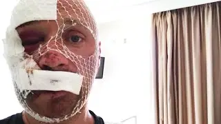 100 STICHE IM GESICHT! Was ist passiert...