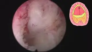 En Bloc MoLEP with early apical release, step by step