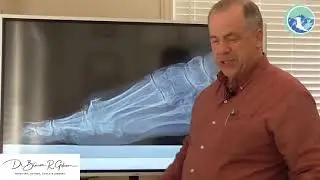 Hallux Limitus/Rigidus