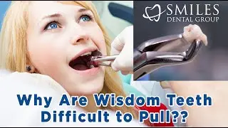 Why Are Wisdom Teeth Hard To Pull? Everything You Need to Know! (2025)