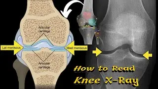 How to Read Knee X-Ray | Medical Technology
