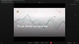 nappropriate sinus tachycardiarocal Atrial tachycardia - Mohamed Bayoumi-