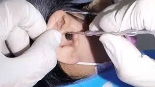 Woman's Earwax PLUG Removal Using Ear Curette