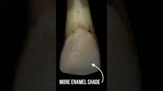 Layering Class IV composite attempt