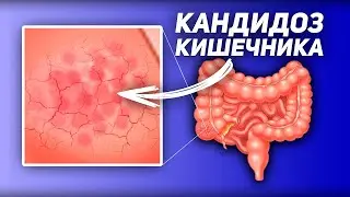 Как ВЫЛЕЧИТЬ Кандидоз Кишечника / У Кандида Альбиканс Нет Шансов, Если Будете Знать ЭТО