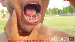 दांतों का मेडिकल टेस्ट कैसे होता है रिमेडिकल से बचना चाहते हैं तो वीडियो देखे 2023