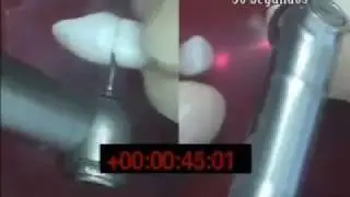 Láseres Fotona - Dental - Velocidad vs. turbina
