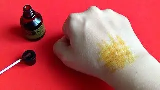 ПРОСТОЙ способ лечения гигромы запястья. БЫСТРЫЙ эффект!!!