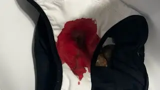 FLUXO INTENSO + COÁGULOS MENSTRUAIS