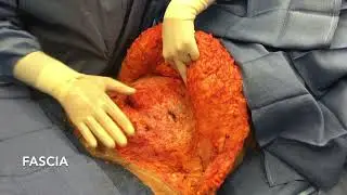 The Tummy Tuck Procedure