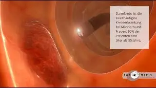 Darmspiegelung zur Darmkrebs Vorsorge - Animation zur Aufklärung und Früherkennung