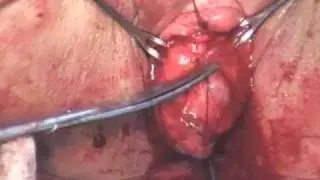Цистоцеле - Gynemesh PS
