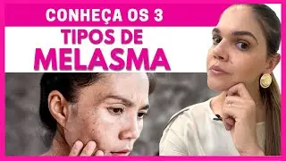 MELASMA REVELADO: OS 3 TIPOS QUE NINGUÉM TE CONTOU!