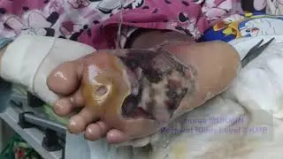 BAU BOROK KAKI DIABETES YANG BIKIN SYOK