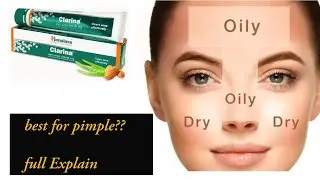 Himalaya Clarina Anti Acne Cream |Honest Review | Benefits side effect ,Uses | supriyatheclassytips