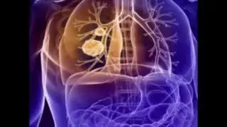 Mesothelioma Lawsuit - What is Mesothelioma and What are its Treatment