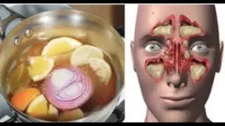 Receita Natural para tratar a Sinusite, Rinite, constipações, e catarro!