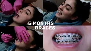 5 MONTHS BRACES UPDATE (POWERCHAINS)