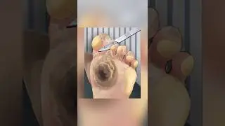 Asmr remove plantar animation 