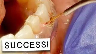 Laser Gum Surgery Success Story: INCREDIBLE Outcome! 🤩