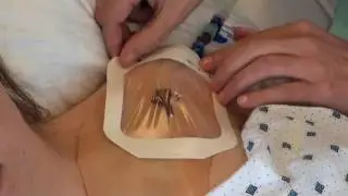 Verzorging CVK