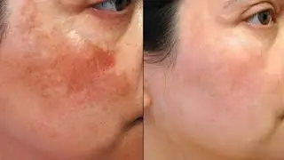 How to prevent Sunburn & tanning ? Honest review of LOTUS BOTANICAL SUNSCREEN #skincare #shystyle