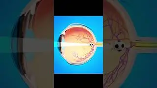 दूर दृष्टिदोष कैसे होता है ? - Hyperopia