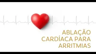 Ablação Cardíaca para Arritmias (tudo o que você precisa saber como paciente).