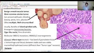 GYN PATHOLOGY: FALLOPIAN TUBE & MESENCHYMAL TUMORS
