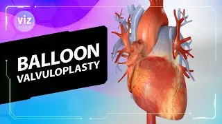 Replacing open-heart surgery with a simple balloon (3D Animation)