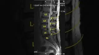 Best Tips for Sciatica pain relief #sciatica #sciaticapainrelief #discbulges #gym #spinalstenosis