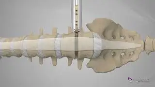 XLIF Patient Education Animation   Spanish v1 0