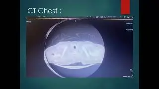 Grand round AO root abscess