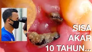 Proses Pencabutan Sisa Akar Gigi Yang Terpendam Selama 10 Tahun | Cabut Gigi | Dokter Gigi Griya RR