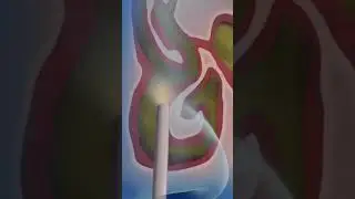 How Balloon Sinuplasty is Performed? 3D Animation (Urdu/Hindi)