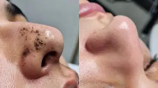 Blackhead Removal Before & After | Deep Cleansing & Pore Cleaning Results