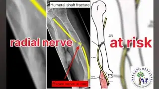 Happy Patient | Humerus Fracture | Broken Arm|Patient Recovery| Pallawi Hospital Mancherial| Dr Raj