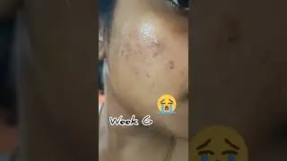😭Watch before buying 10% Niacinamide serum testing for 6 weeks 