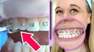 Putting Braces On My Teeth | Which Braces Color Did I Choose?!