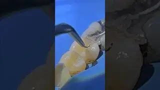 Direct composite restorations using SFRC (GC everX flow + G-aenial sculpt) 